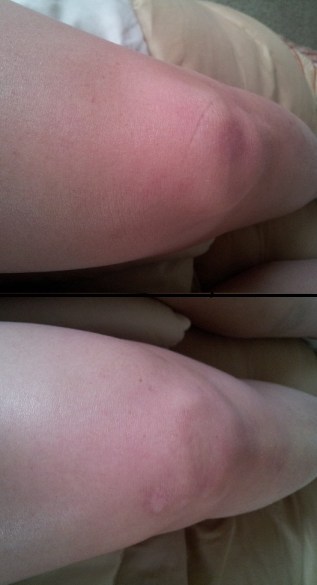 Taken at as close to the same angle and perspective as possible. Sad face.